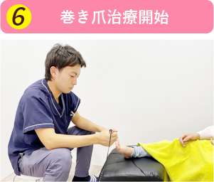 巻き爪治療開始